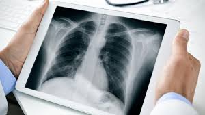 The Vital Role of Rare Lung Cells in Cystic Fibrosis: New Study Sheds Light