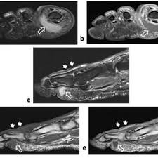 The flexor digiti minimi brevis (flexor brevis minimi digiti, flexor digiti quinti brevis) lies under the metatarsal bone on the little toe, and resembles one of the interossei. Pdf Diabetic Foot Spectrum Of Mr Imaging Findings