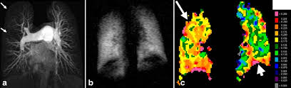 Chronic thromboembolic pulmonary hypertension — assessment by magnetic  resonance imaging