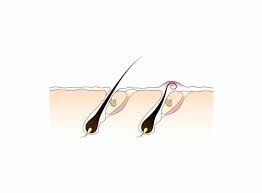 Das neue haar wächst aus demselben haarfollikel nach. Eingewachsene Haare Heilpraxis