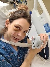 Update: Her healing hasn't been the best. We were hoping they would take  the hardware off of her leg but it just isn't time. Another surgery