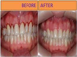 The most common cause of gingivitis is poor oral hygiene that encourages plaque to form on teeth, causing inflammation of the surrounding gum tissues. How To Get Rid Of Gingivitis At Home Step By Step Gingivitis Gum Disease Gum Disease Treatment