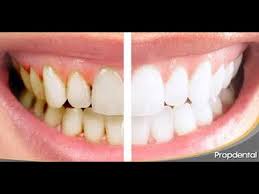Dientes Amarillos