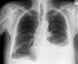 Bilateral well defined irregular shadows that are as dense as the. Pleural Effusion Chest X Ray Medschool