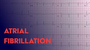 Atrial Fibrillation Afib Ekg Ecg Interpretation Youtube
