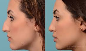 20 year old female patient from manhattan wanted the bump. Rhinoplasty Ontario Dr Oakley Smith Surgeon