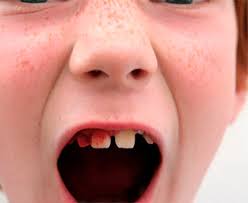 Check spelling or type a new query. Gingivit U Detej Stomatologicheskaya Klinika 32dent Kiev