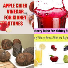 So drinking a minimum of twelve glasses per day is very important in helping the body get rid of the kidney stones as well as in preventing more from forming. The Best Kidney Stone Home Remedy The Kidney Stone Remedy