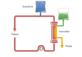 The 2008t hemodialysis machine is indicated for acute and chronic dialysis. Crrt Setups Standard Therapies For Acute Kidney Injury Fresenius Medical Care