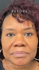 Laura Cady BSN, RN, CANS