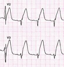 However, cardiac markers are not elevated. Awmi Definition Of Awmi By Medical Dictionary