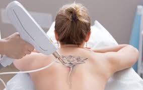 First, before learning how to remove tattoos at home fast and naturally, you might need to look over some of the most common reasons for people to get if you opt for using a red ink tattoo to cover up a tattoo done in black ink, then it is actually not possible because the stronger color will completely. Tattoo Removal Dermatology