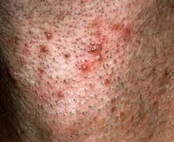 The condition is most prevalent among people who have coarse or curly hair. Ingrown Vs Folliculitis Understand The Difference Cool Men S Hair