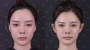 And keep in mind, there are not a great deal of body adjustment artists who do this kind of procedure. Elf Ears Are Trending In China People Are Undergoing Surgery To Get Them