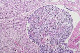 1998, issue of the journal of the national cancer institute suggests that the rise in incidence from 1983 through 1986 may not have represented a true increase in the number of cases, but may have reflected new forms of imaging equipment (magnetic. Cancer Rates In Young Children Are Increasing Worldwide