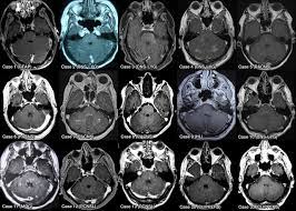Dopaminergic agents in restless legs syndrome and dyskinesias while awake and periodic movements in sleep in restless legs syndrome: Clippers And Its Mimics Evaluation Of New Criteria For The Diagnosis Of Clippers Journal Of Neurology Neurosurgery Psychiatry