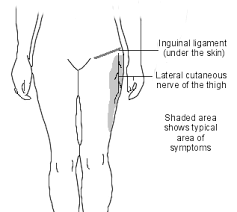 Among the hypotheses advanced to explain this frequency, the role played by the inguinal ligament was underlined. Inguinal Ligament And Nerve Entrapment At The Groin A Key Player In Hip Leg Pain