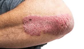 Image result for psoriasis