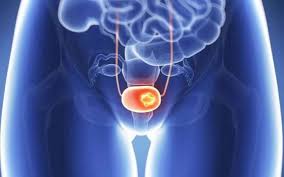 One of the world's leading experts in bioweapons is dr. Bladder Cancer On A Rise In India Mio Hospital