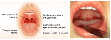 Gnojnaya Angina U Rebenka I Vzroslogo Lechenie Gnojnoj Anginy V Domashnih Usloviyah