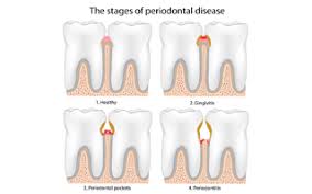 How to strengthen teeth and gums. Help For Receding Gums Ayurvedic Health Center Guided Transformation