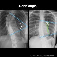 How To Measure Scoliosis Scoliosis Radiology Radiology Imaging