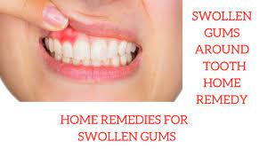 Swollen Gums Around Tooth Home Remedy | Home Remedies For Swollen Gums -  Youtube