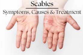 Image result for scabies human symptoms