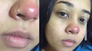 Infektion Mit Staphylococcus Aureus Layane Wollte Ein Piercing Und Landete Im Rollstuhl