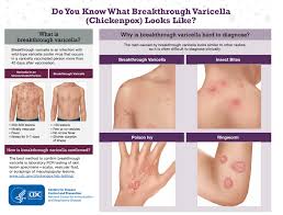 Image result for Varicella zoster on human skin