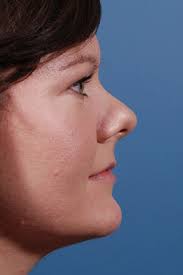 Dallas Rhinoplasty Center in Dallas-Fort Worth TX