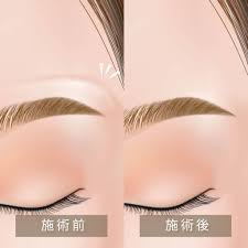 眉上ボトックス - eクリニック横浜みなとみらい院【公式】｜横浜の美容整形・美容外科