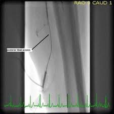 Above the Knee Peripheral Artery Intervention