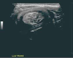 We did not find results for: Pediatric Colocolic Intussusception With Pathologic Lead Point A Case Report Abrahams Journal Of Medical Cases