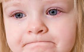 Image result for Allergic Conjunctivitis