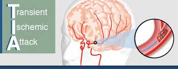 Mri Scans And Transient Ischemic Attack Mini Strokes Timeliness Makes A Difference Precise Imaging
