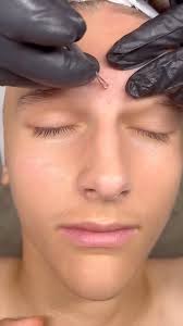 Battling those teenage breakouts, one extraction at a time. 💫🧴  #ClearSkinJourney #TeenBeauty #extractions #teenacne #blackheads #skincare  #facial #acnefacial #blackheadextractionsfacials