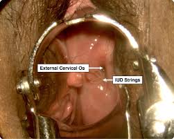 To make sure your iud hasn't moved, some experts recommend checking these strings every month after you get your. Loop Electrosurgical Excision Procedure With An Intrauterine Device In Place American Journal Of Obstetrics Gynecology