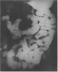 Image result for Intestinal Enteropathy