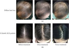 I am worried that i'll develop rebound headaches. Effectiveness And Safety Of Botulinum Toxin Type A In The Treatment Of Androgenetic Alopecia