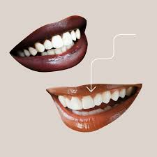 Less expensive than porcelain veneers. Dental Veneers Guide For 2021 The Cost Risks And Procedure