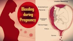 #whitedischarge how to identify the pregnancy symptoms with white. à®•à®° à®ª à®ª à®• à®²à®¤ à®¤ à®² à®‡à®°à®¤ à®¤ à®•à®š à®µ à®à®± à®ªà®Ÿ à®µà®¤à®± à®• à®© à®• à®°à®£à®™ à®•à®³ Causes Of Bleeding During Pregnancy