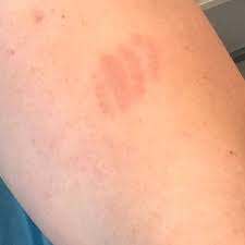 Juckreiz kann bei tumorpatienten aus den unterschiedlichsten gründen auftreten. Was Konnte Mich Da Gestochen Haben Seit 3 Tagen Juckreiz Stich Hautausschlag