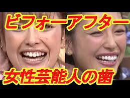 安室奈美恵も こんなに変わる 歯並びが綺麗に整った女性芸能人ビフォーアフター 芸能デスク before after youtube 歯並び 綺麗 芸能人 歯 顔のエクササイズ