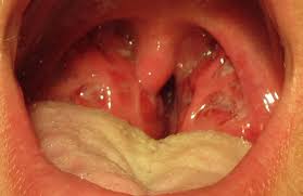 This clearly shows the growth of infection and bacteria in your mouth. Holes In Tonsils Causes Symptoms And Treatment