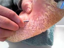 You will also find helpful home remedies to soothe your skin. Foot In Cast Toes Peeling