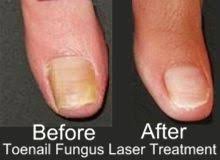 Fungal Nail Infection Laser Treatment Cost Nailstip