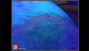 Image result for Erythrasma