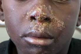 Image result for yellow scabs on the face in children