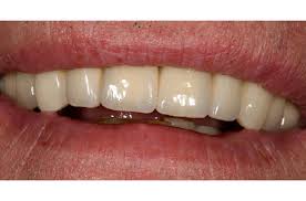 We did not find results for: Bridges The St Peter S Dental Practice